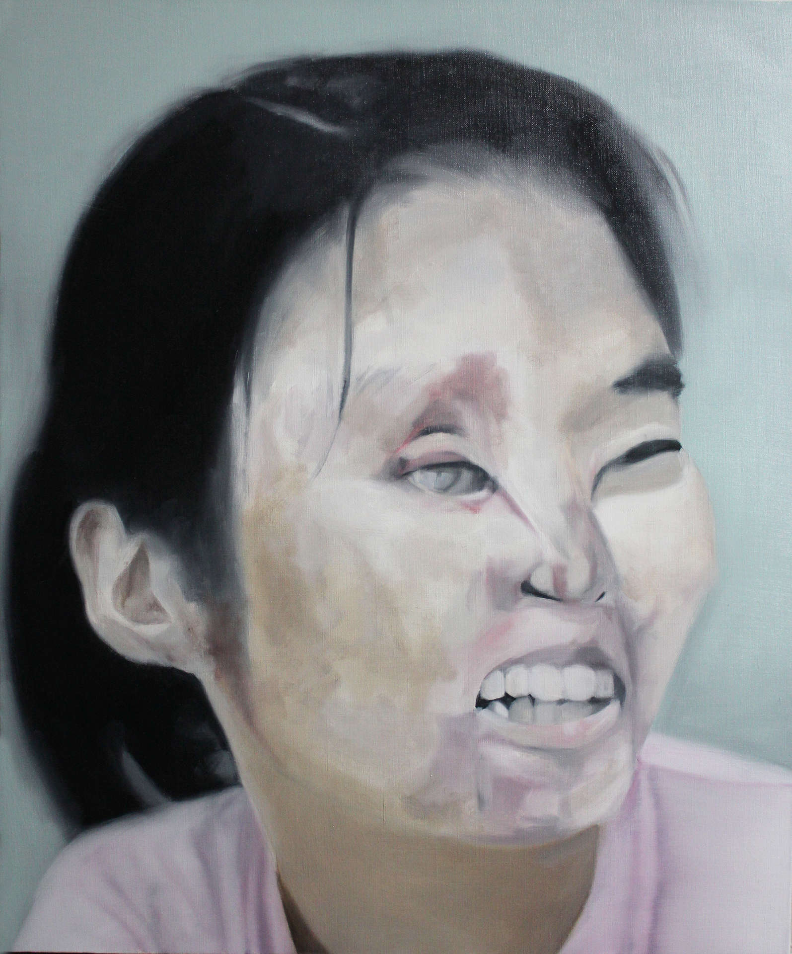 Acid Attack Victim (5)